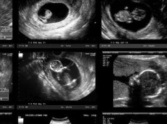 有姐妹知道2026年新疆哪里做试管婴儿的技术比较好吗？